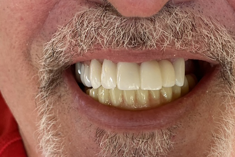 patient's after smile