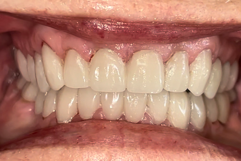 patient's after smile