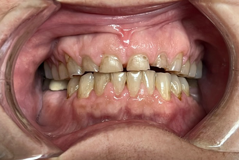 patient's before smile